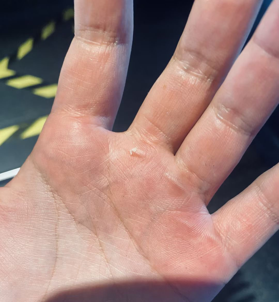 体育生手部粗糙成因与影响分析